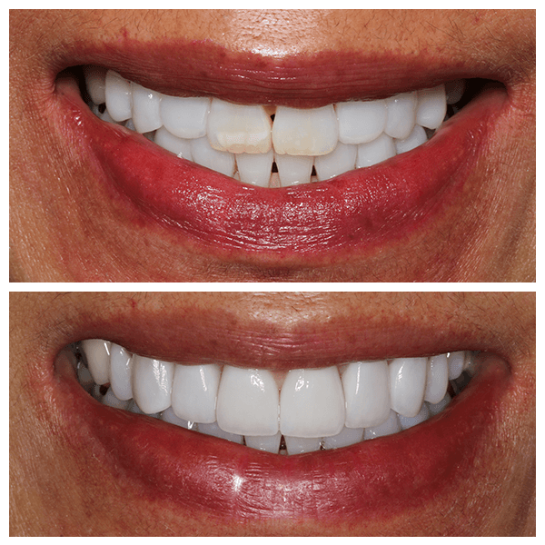 Cali Dental Arts Before and After Photo