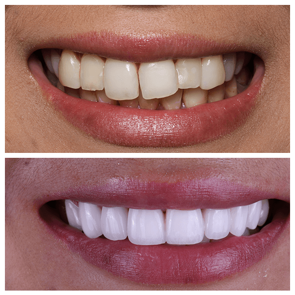 Cali Dental Arts Before and After Photo