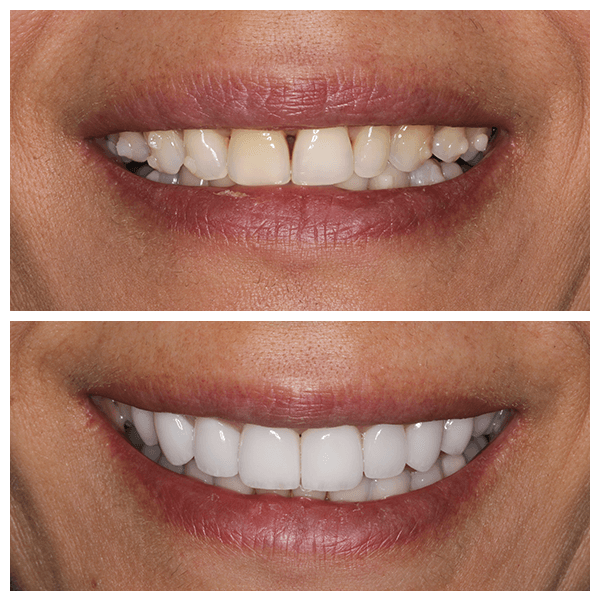 Cali Dental Arts Before and After Photo