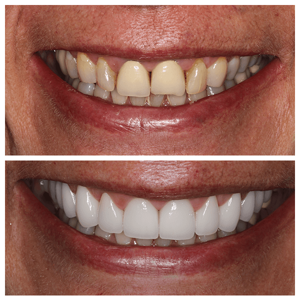 Cali Dental Arts Before and After Photo