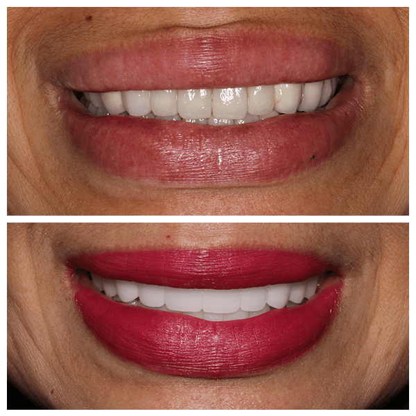 Cali Dental Arts Before and After Photo