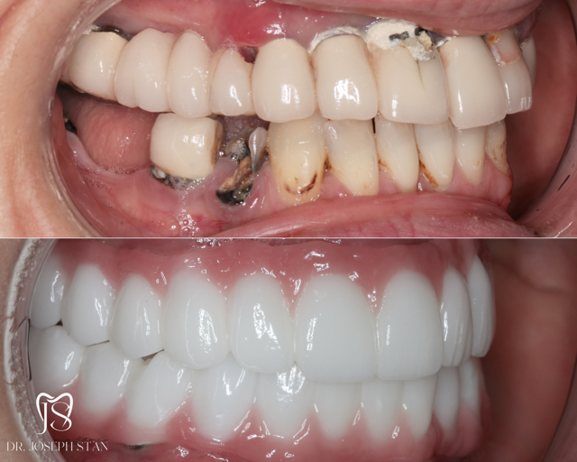 Cali Dental Arts Before and After Photo