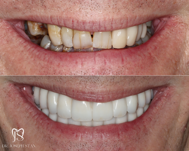 Cali Dental Arts Before and After Photo