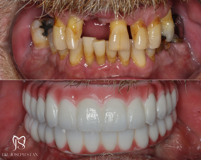 Cali Dental Arts Before and After Photo