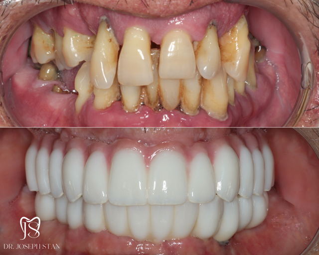 Cali Dental Arts Before and After Photo