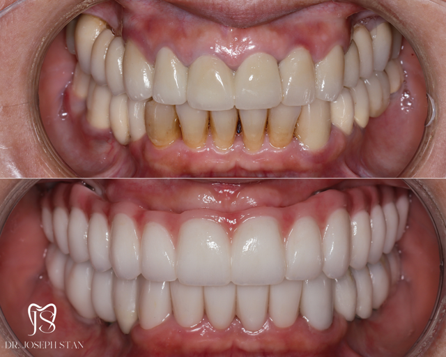 Cali Dental Arts Before and After Photo