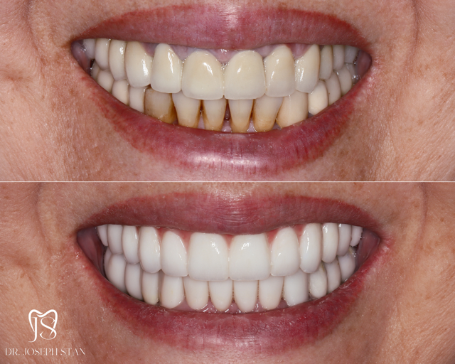 Cali Dental Arts Before and After Photo
