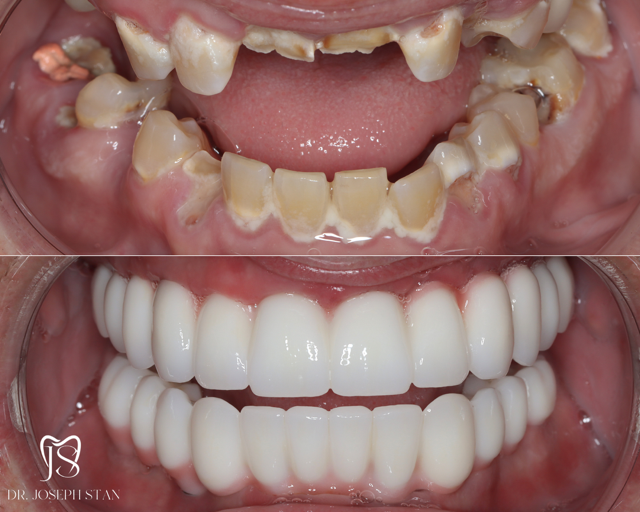 Cali Dental Arts Before and After Photo
