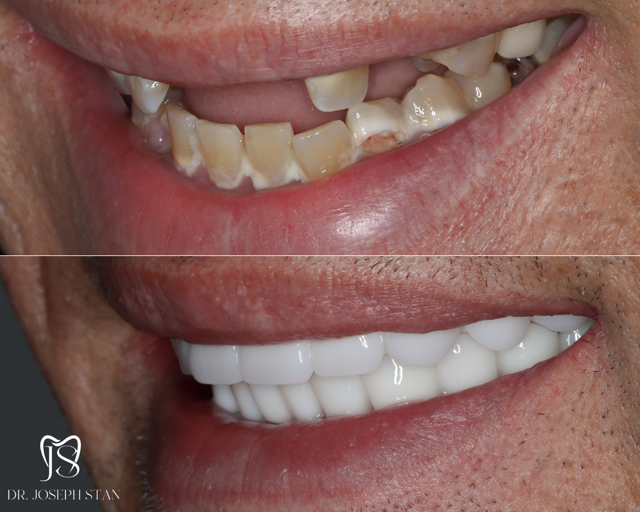Cali Dental Arts Before and After Photo