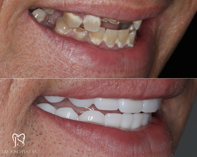 Cali Dental Arts Before and After Photo