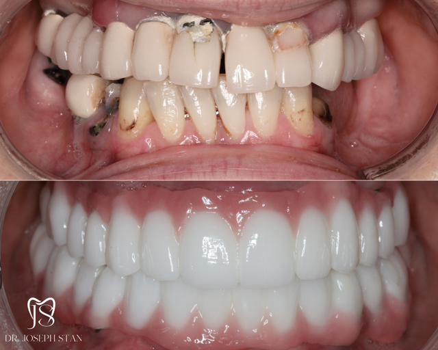 Cali Dental Arts Before and After Photo