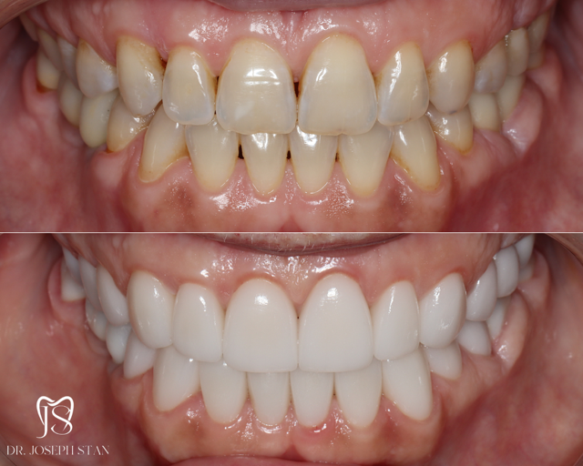Cali Dental Arts Before and After Photo