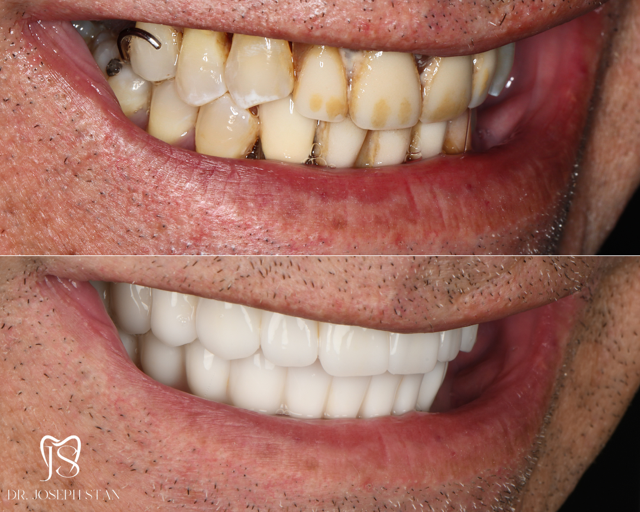 Cali Dental Arts Before and After Photo