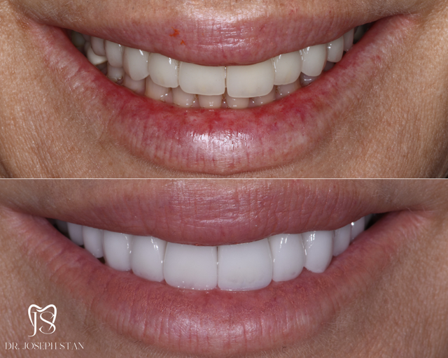Cali Dental Arts Before and After Photo