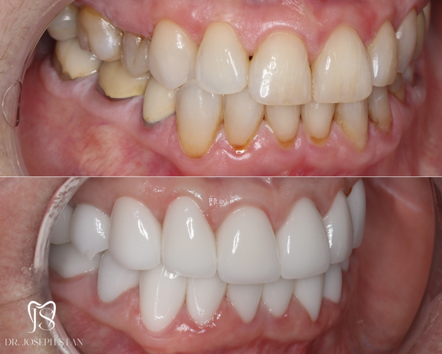 Cali Dental Arts Before and After Photo