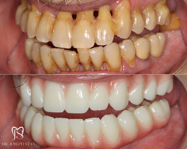 Cali Dental Arts Before and After Photo